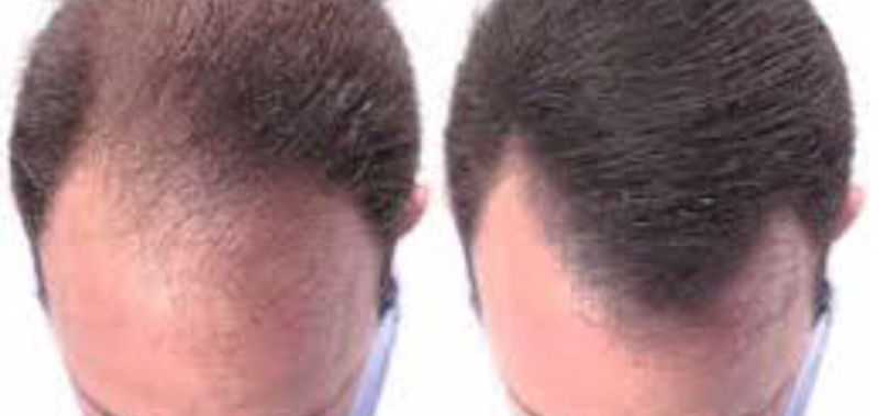 Two photos side by side showing the process of hair rejuvenation on a man's head