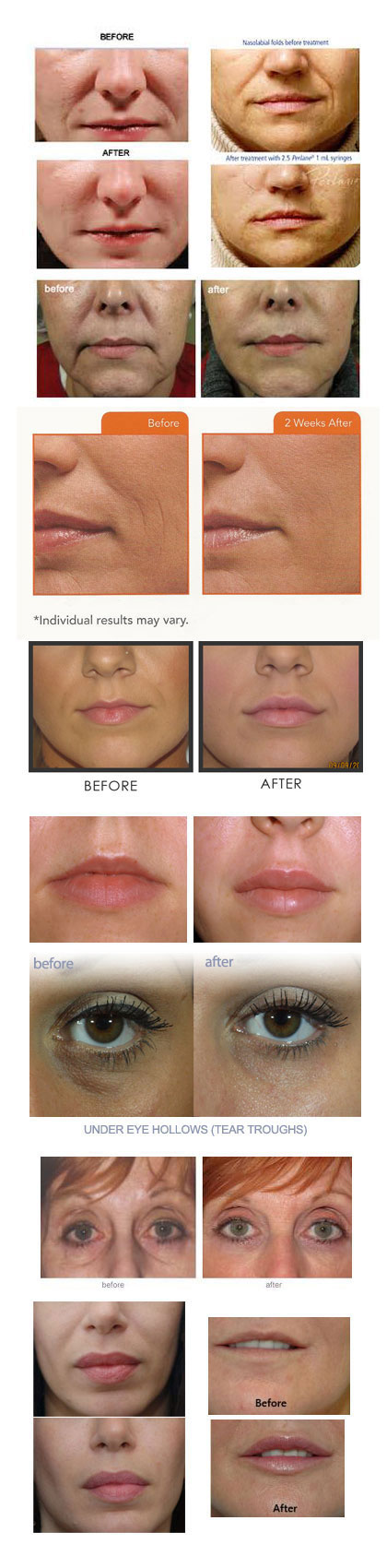 Juvederm Before and After photos