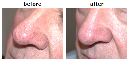 Close up of man's nose showing reduction of spider veins